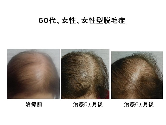 円形脱毛症　病院